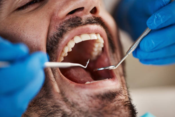 Best Emergency Treatment for Dental Infections or Abscesses in Cortez, FL