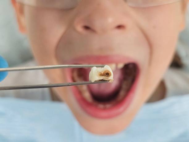 Best Emergency Tooth Extraction in Cortez, FL
